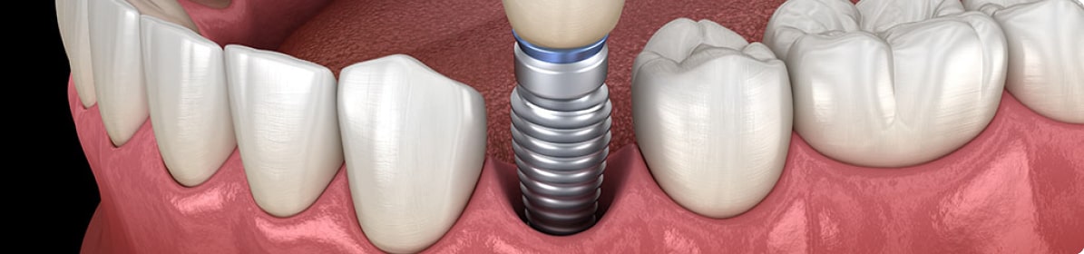 まわりの歯に負担をかけません