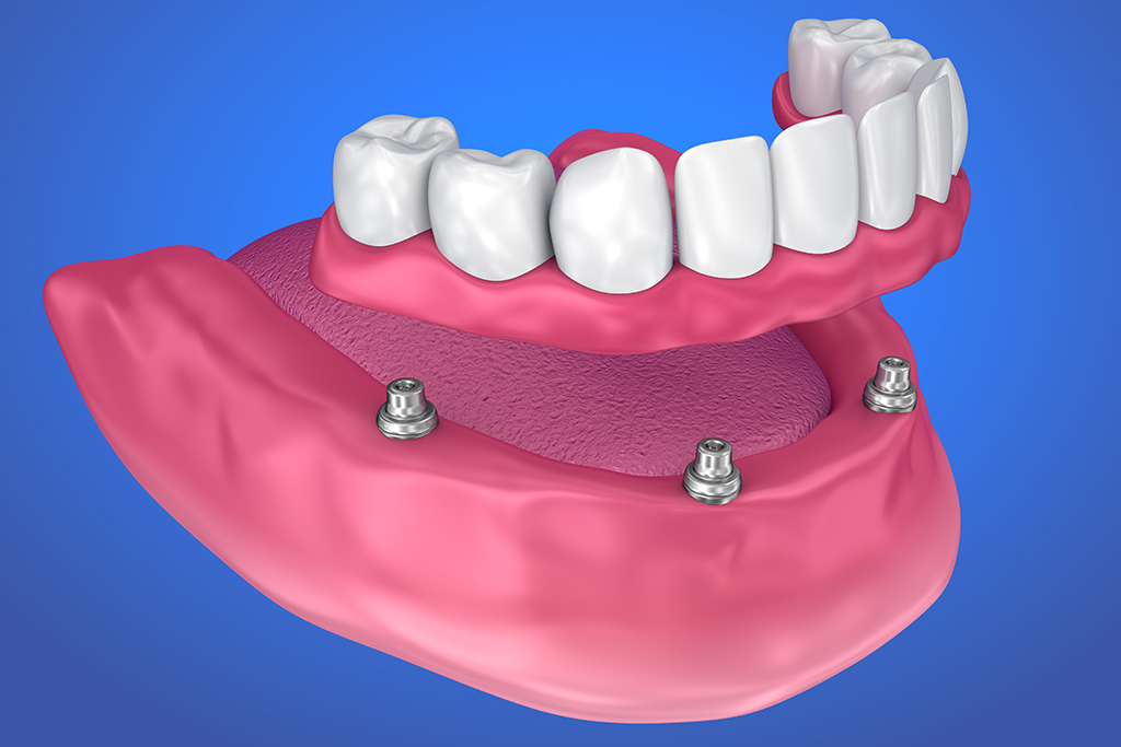 インプラントを使用した入れ歯