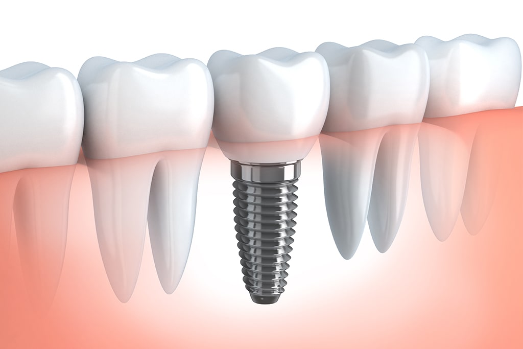 インプラント治療