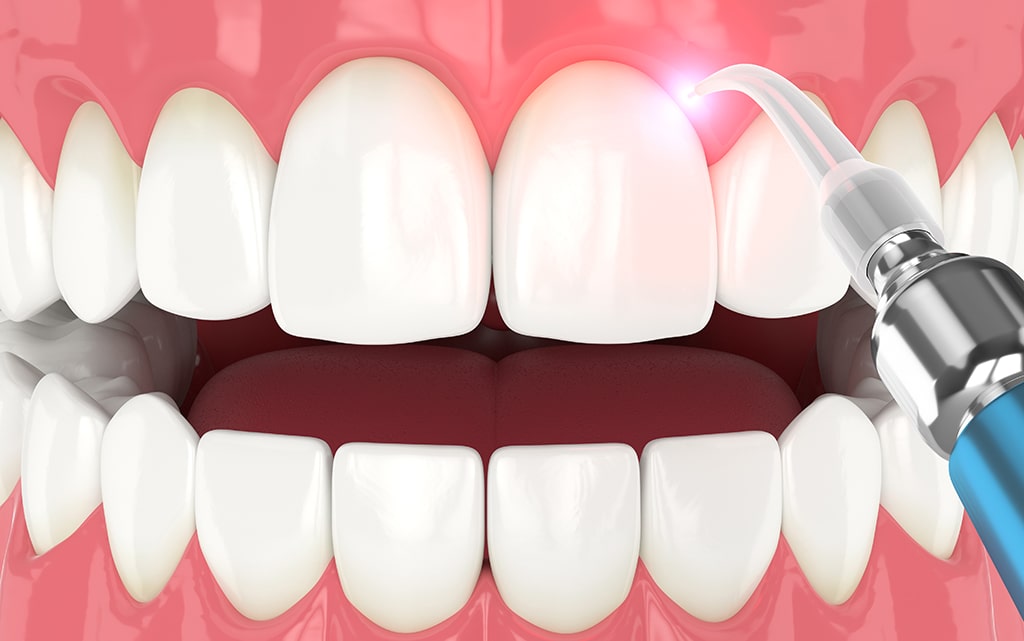 ガムピーリング