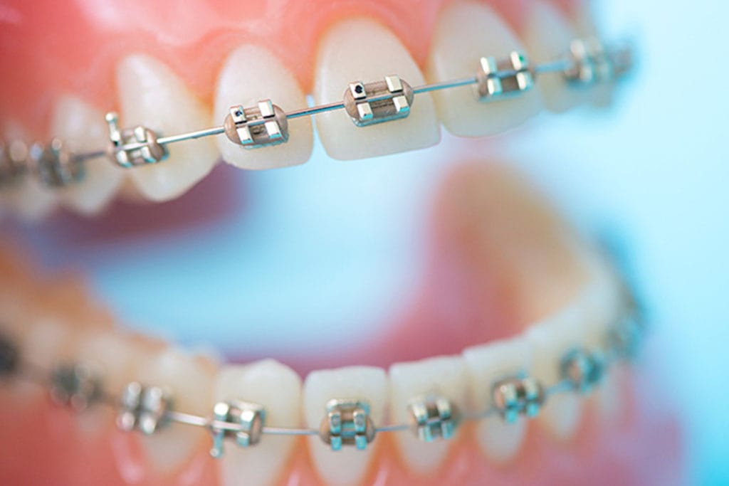 メタルブラケット