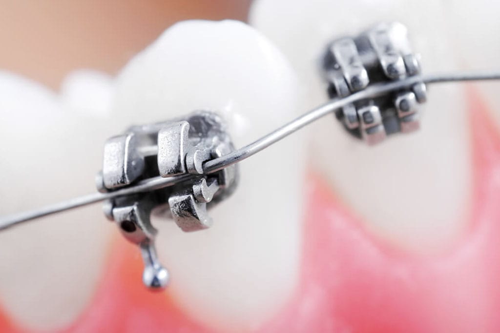 部分矯正で、前歯のガタガタや隙間を改善