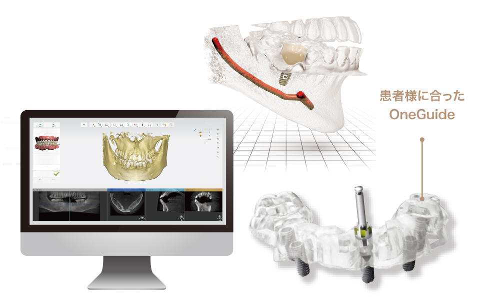 サージカルガイド使用率100%