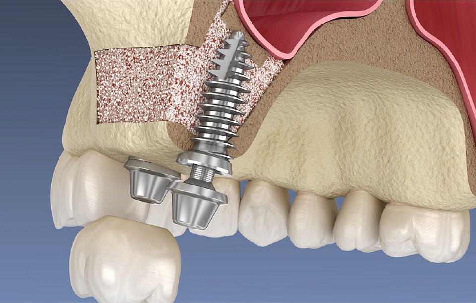 難症例も骨造成やCGF再生療法などの技術で対応