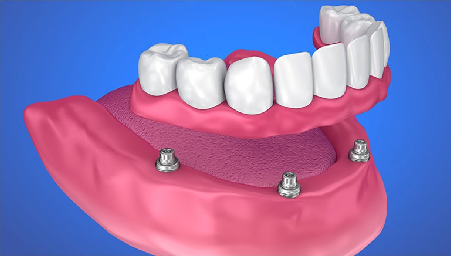 インプラントを使った入れ歯