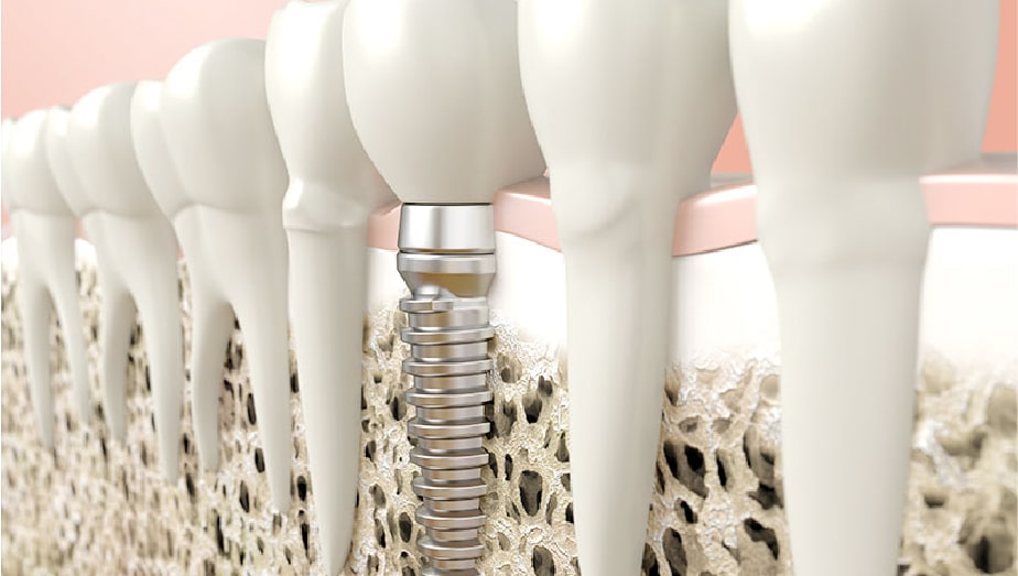 骨が足りない方のための骨造成と再生療法