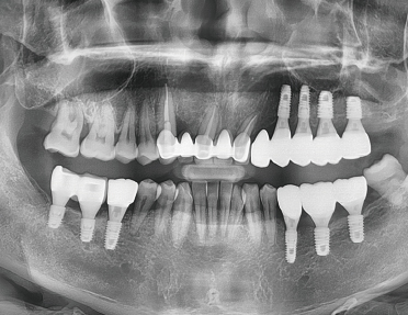 人工歯の精度が高まる