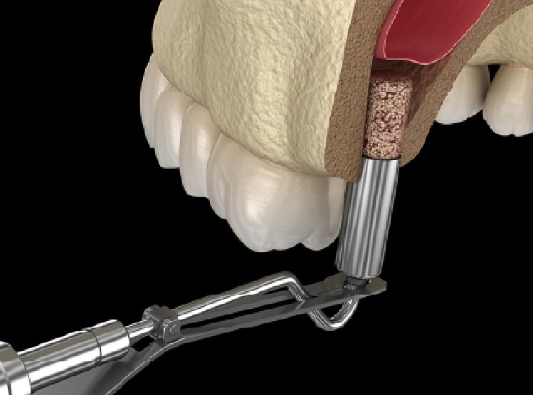 ソケットリフト