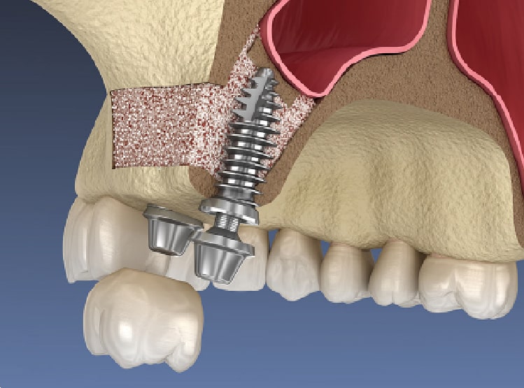 サイナスリフト