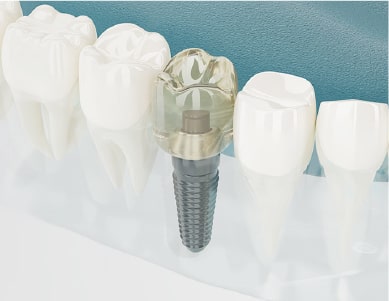 周囲の歯への影響